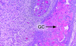 Detail ghost cell-tumor (2)