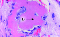 Detail ghost cell-tumor (3)