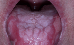 Ernstige graft-versus-hostziekte van tong