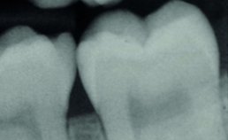 Carieuze laesie in buitenste deel dentine