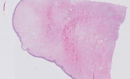 Histopathologisch beeld van fibro-epitheliale laesie