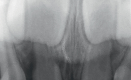 Intraorale röntgenopname front bij kind