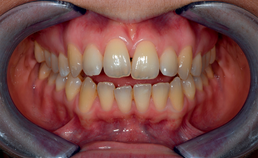 Vooraanzicht dentitie in maximale occlusie