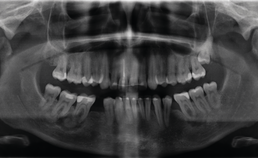 Floride osseuze dysplasie in molaarstreek onderkaak