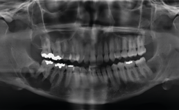 Periapicale radiolucenties ter plekke van laatste molaren onderkaak