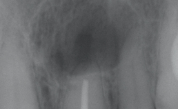 Parodontale spleet intact na endodontische behandeling