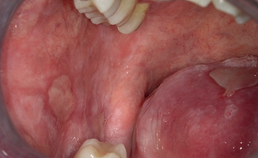 Lichenoïde veranderingen en ulceraties op wangslijmvlies en tong