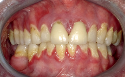 Ernstige orale cGVHD door ontstoken en atrofische gingiva