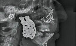  Laterale röntgenschedelprofielopname van de postoperatieve situatie 
