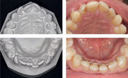 Tandstand van hoornist voor en na orthodontische behandeling