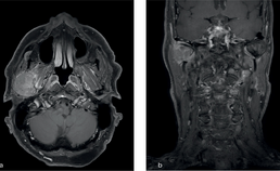 Ossale laesie in mandibulaire condyl rechts, ossale destructie en extensie in de masticatoraloge