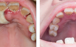 Necrotiserende ulcererende parodontitis bij patiënt met GSD1B