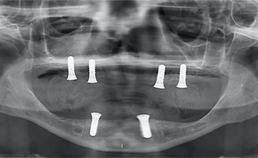 Implantaten geplaatst bij patiënt met GSD1B