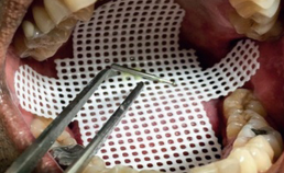 Beschermgaas gebruikt door de tandarts