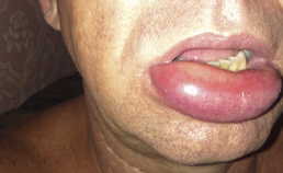 Angio-oedeem van lip