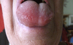 Angio-oedeem van tong