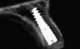 Immediaat geplaatste fronttandimplantaten 1. Analyse met conebeamcomputertomografie naar remodellering van  de bucclae botlamel