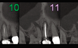 Endodontologie in beweging: nieuwe concepten, materialen en technieken 2. Conebeamcomputer­tomografie in de endodontische diagnostiek en behandelplanning - 1b