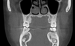CBCT-scan met coronale coupe