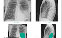 röntgenopname met ronde consolidatie in linker hemithorax