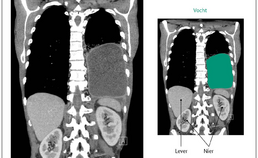 CT-scan met vocht gevulde holte linker long