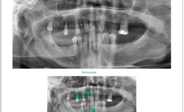 beperkte dentitie en meerdere gebieden van botdestructie