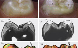 lichtmicroscopische beelden van molaar na 3 maanden erosieve belasting