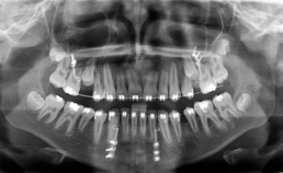 Fractuur van collum mandibulae