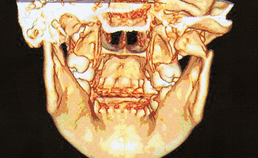 Fractuur van collum mandibulae