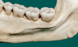 Linguale mandibulaire osteonecrose