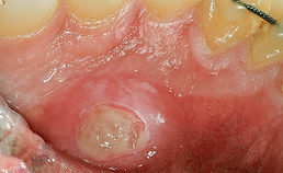 Linguale mandibulaire osteonecrose