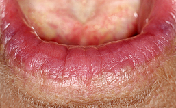 Oral medicine 6. Ulceraties van de orale mucosa