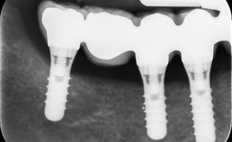Implantaatgedragen kronen en bruggen bij parodontaal gecompromitteerde patiënten