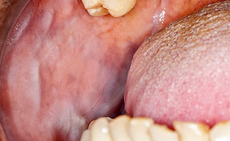 Oral medicine 7. Witte veranderingen van het mondslijmvlies