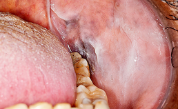 Oral medicine 7. Witte veranderingen van het mondslijmvlies