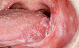 Oral medicine 7. White lesions of the oral mucosa