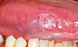 Oral medicine 8. Leukoplakie van het mondslijmvlies