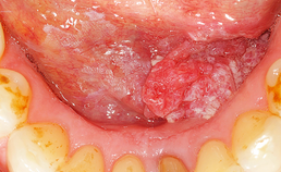Oral medicine 8. Leukoplakia of the oral mucosa