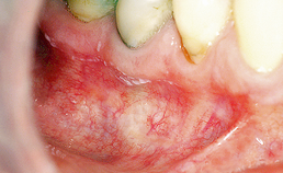 Oral medicine 8. Leukoplakie van het mondslijmvlies