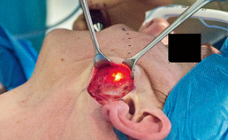 Sialendoscopie: endoscopische benadering van obstructieve speekselklieraandoeningen