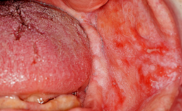 Oral medicine 9. Lichen planus en lichenoïde afwijkingen van het mondslijmvlies