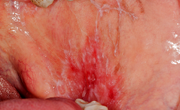 Oral medicine 9.  Lichen planus en lichenoïde afwijkingen van het mondslijmvlies