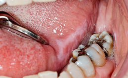 Oral medicine 9. Lichen planus en lichenoïde afwijkingen van het mondslijmvlies