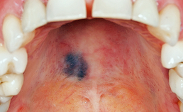 Oral medicine 10. Pigmentaties van het mondslijmvlies