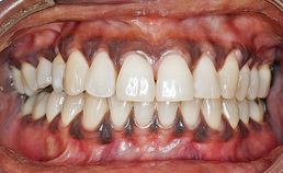 Oral medicine 10. Pigmentaties van het mondslijmvlies