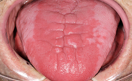 Oral medicine 11. Rode en blauwe veranderingen van het mondslijmvlies
