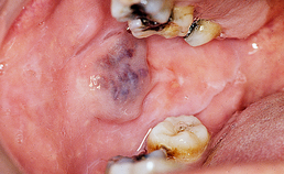 Oral medicine 11. Rode en blauwe veranderingen van het mondslijmvlies