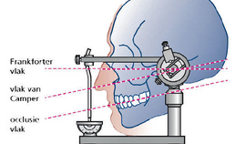 Bepaling en registratie van de maxillomandibulaire relatie bij de vervaardiging van kronen en bruggen