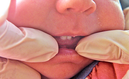(Con)natale gebitselementen: een rol voor kraamzorg en tandheelkundige zorg