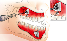 Interceptieve behandeling van een maxillaire hypoplasie met behulp van botankers. Een literatuuronderzoek